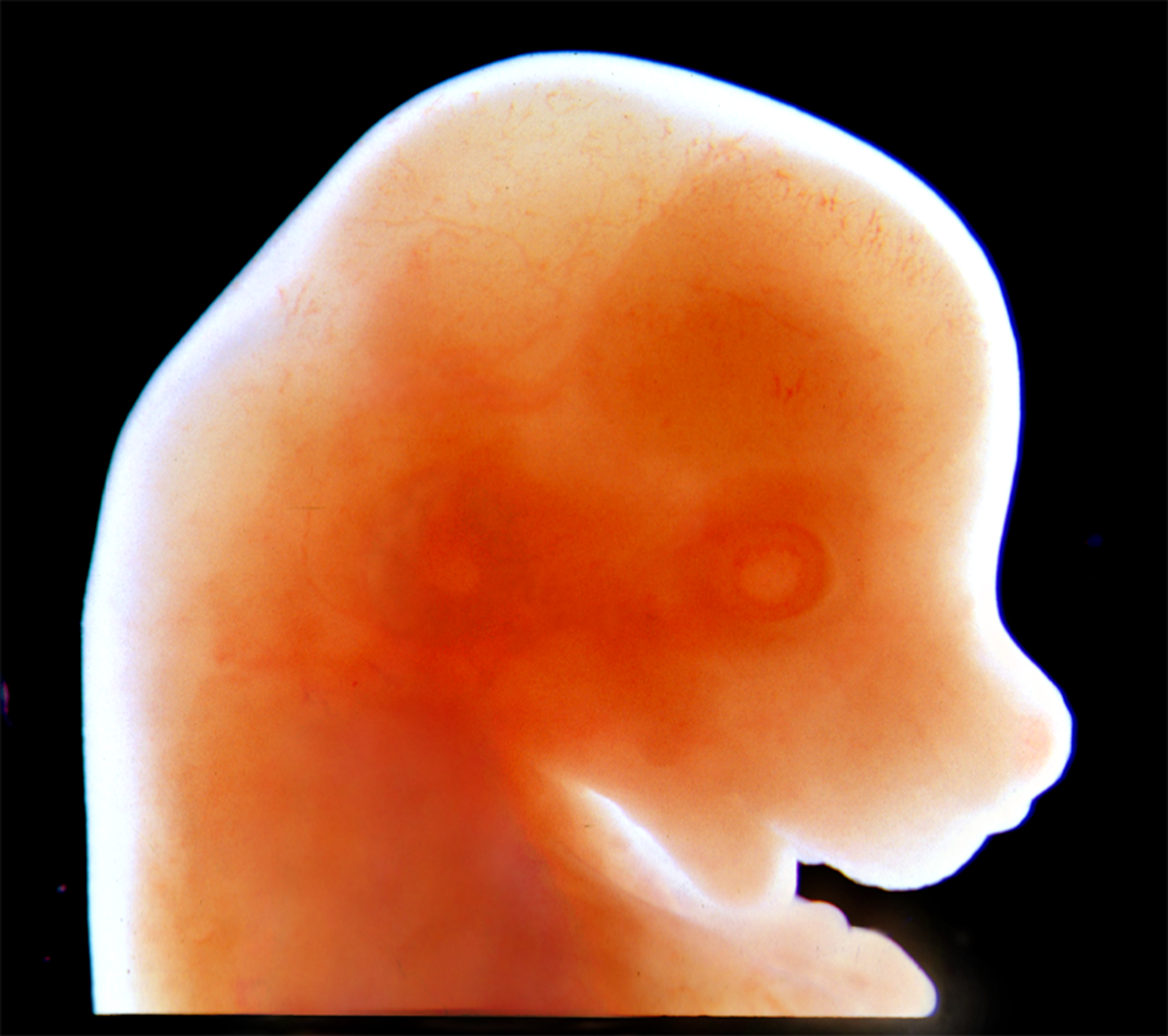 Early exposure to the HD protein may cause life-long symptoms